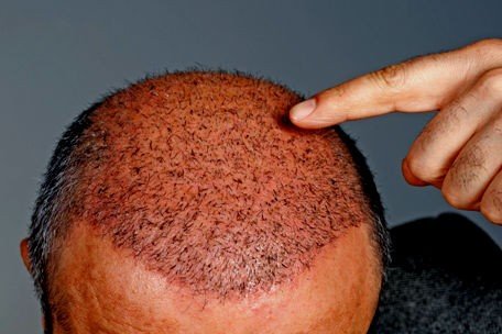 hair transplant